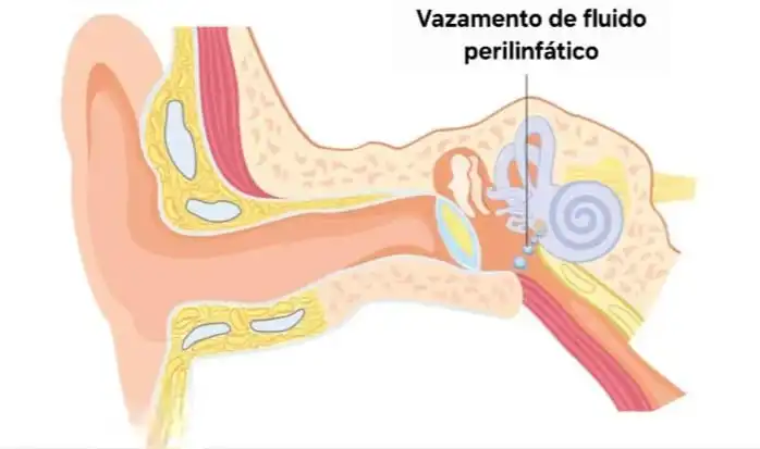 Vazamento de fluido perilinfático - Fistula perilinfática